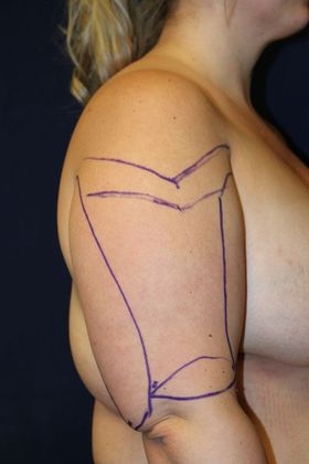 Arm Lift*/Arm Sculpting: Case 14 - Before