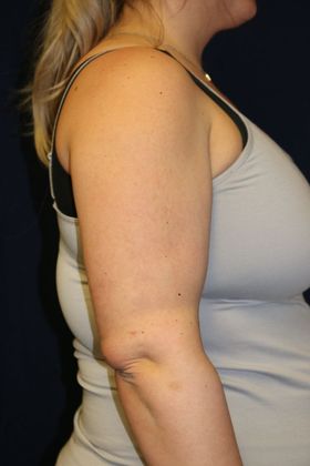 Arm Lift*/Arm Sculpting: Case 14 - After