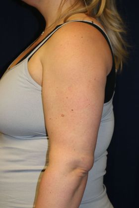 Arm Lift*/Arm Sculpting: Case 14 - After