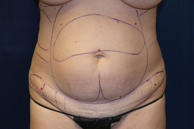 Liposuction & Safe Lipo: Case 46 - Before