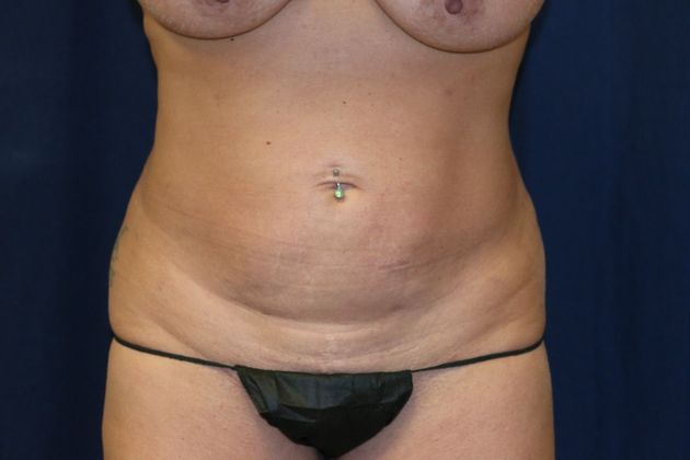 Liposuction & Safe Lipo: Case 46 - After