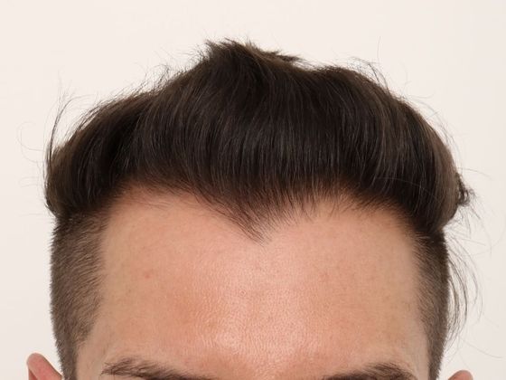 Male Before And After Hair Transplant Photos Frontal FUE (5) - After