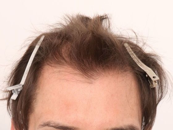 Male Before And After Hair Transplant Photos Frontal FUE (5) - Before