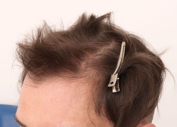 Hair Transplant - Male: Frontal FUE - Case 28 - Before FUE hair transplant