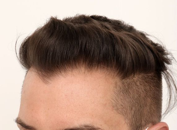 Hair Transplant - Male: Frontal FUE - Case 28 - After FUE hair transplant