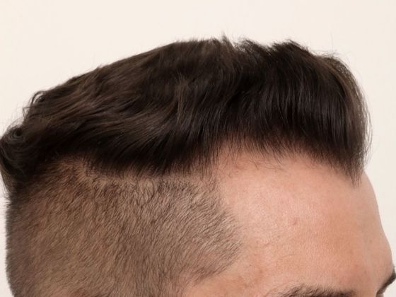 Hair Transplant - Male: Frontal FUE - Case 28 - After FUE hair transplant