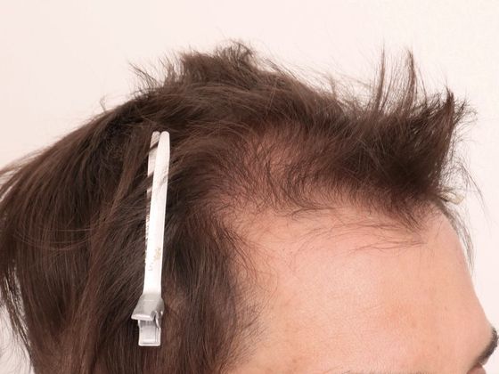 Hair Transplant - Male: Frontal FUE - Case 28 - Before FUE hair transplant