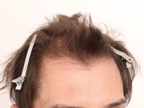 Hair Transplant - Male: Frontal FUE - Case 28 - Before FUE hair transplant