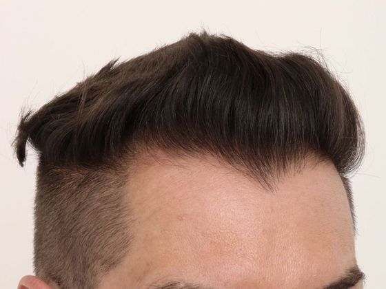 Hair Transplant - Male: Frontal FUE - Case 28 - After FUE hair transplant