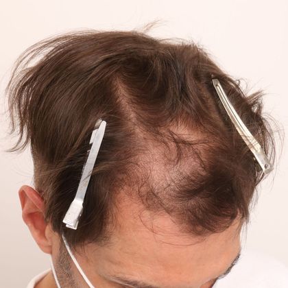 Hair Transplant - Male: Frontal FUE - Case 28 - Before FUE hair transplant