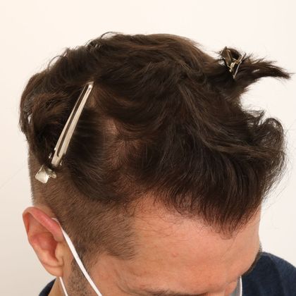 Hair Transplant - Male: Frontal FUE - Case 28 - After FUE hair transplant