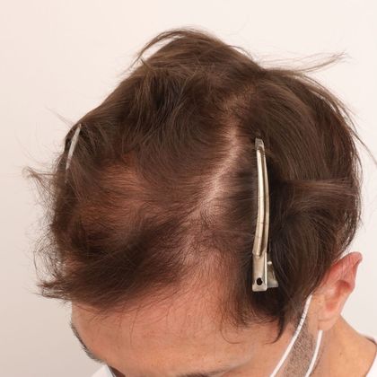 Hair Transplant - Male: Frontal FUE - Case 28 - Before FUE hair transplant