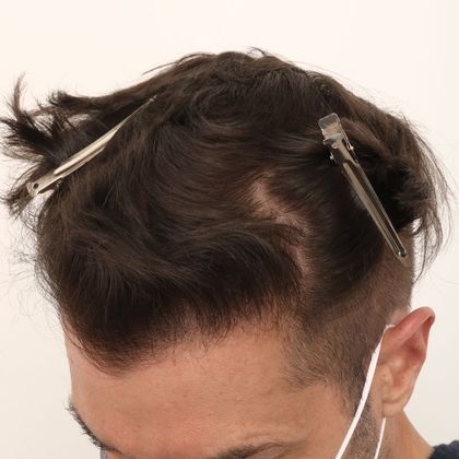 Hair Transplant - Male: Frontal FUE - Case 28 - After FUE hair transplant