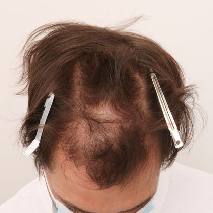 Hair Transplant - Male: Frontal FUE - Case 28 - Before FUE hair transplant