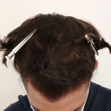 Hair Transplant - Male: Frontal FUE - Case 28 - After FUE hair transplant