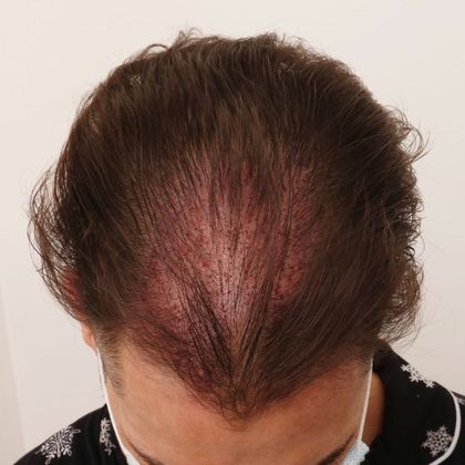 Hair Transplant - Male: Frontal FUE - Case 28 - Before FUE hair transplant