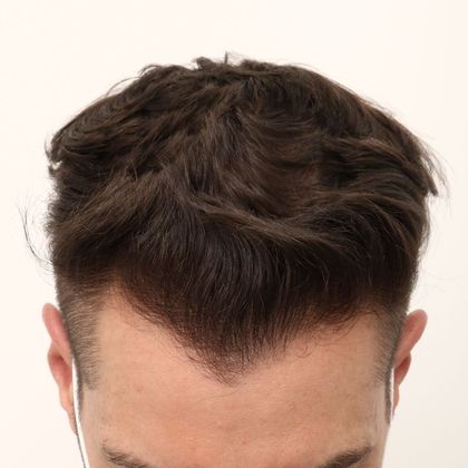 Hair Transplant - Male: Frontal FUE - Case 28 - After FUE hair transplant