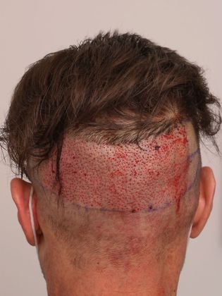 Hair Transplant - Male: Frontal FUE - Case 28 - Post-op FUE hair transplant