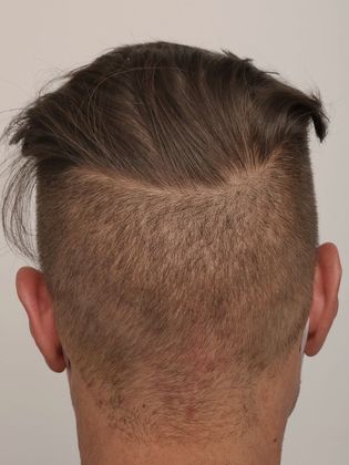 Hair Transplant - Male: Frontal FUE - Case 28 - Donor area healed after FUE hair transplant