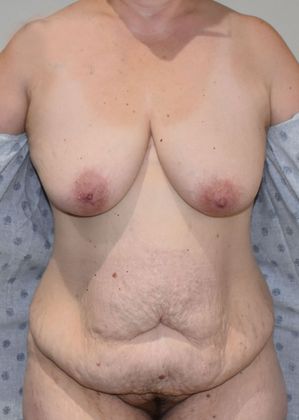 Mommy Makeover Case 221 - Before