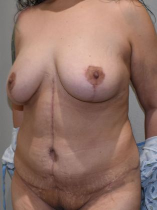 Mommy Makeover: Case 222 - After