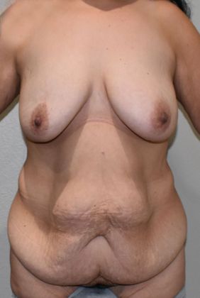 Massive Weight Loss  Case 97 - Before