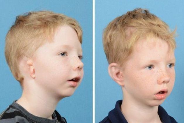 Both Ears: Before & After - BEFORE & AFTER Danish boy 1yr. after right & 3 weeks after left ear reconstruction