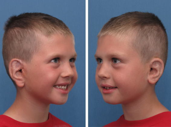 Both Ears: Before & After - AFTER 4yrs. after left and right ear & canal reconstruction