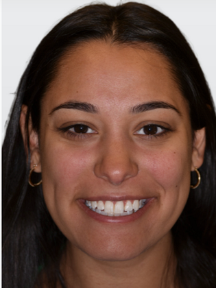 Veneers: Gabriella R. - Before