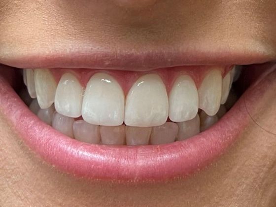Veneers: Gabriella R. - After