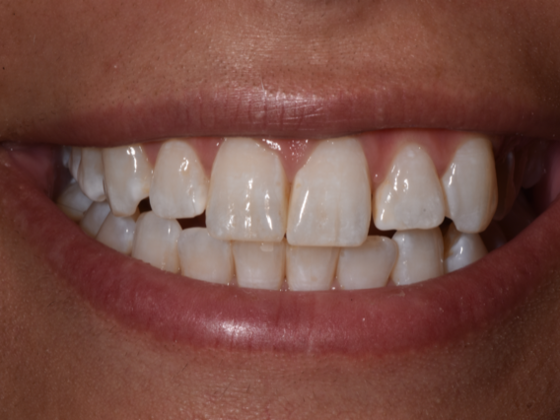 Veneers: Gabriella R. - Before