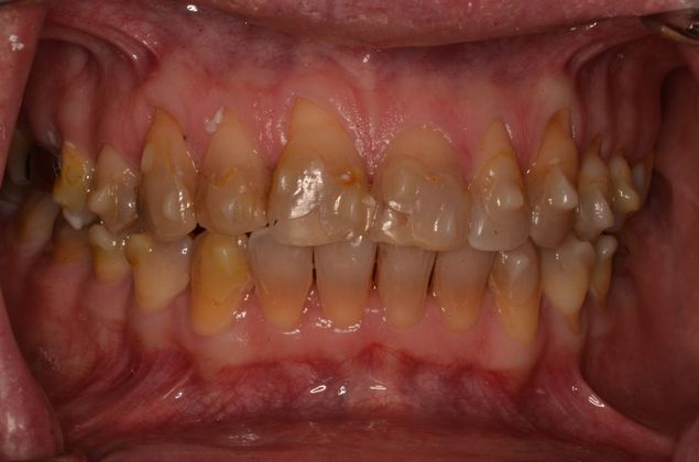 Tetracycline staining: Case 1 - Before