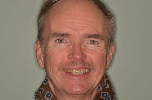 Tetracycline staining Case 1 - Before