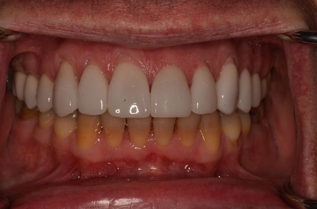 Tetracycline staining: Case 1 - After