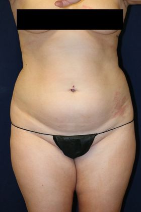 Liposuction & Safe Lipo: Case 48 - Before
