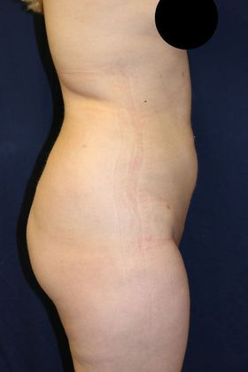 Liposuction & Safe Lipo: Case 48 - After