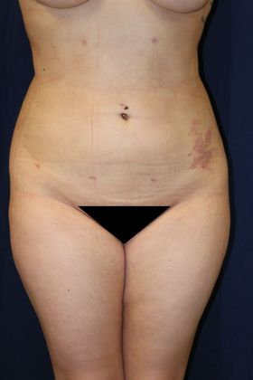 Liposuction & Safe Lipo: Case 48 - After