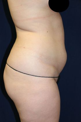Liposuction & Safe Lipo: Case 48 - Before