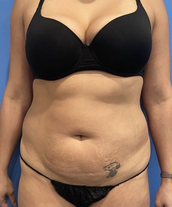 Liposuction: Case 18 Liposuction Monroe, CT - Before