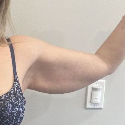 Arm Lift Case 5 Arm Lift/ Brachioplasty, Shelton, CT - Before