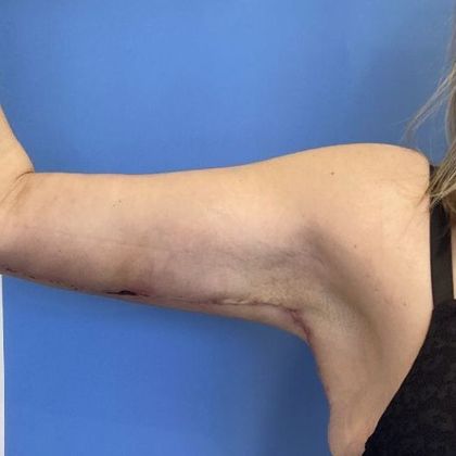 Arm Lift Case 5 Arm Lift/ Brachioplasty, Shelton, CT - After