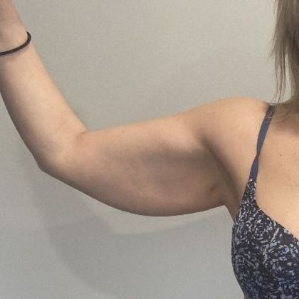 Arm Lift: Case 5 Arm Lift/ Brachioplasty, Shelton, CT - Before
