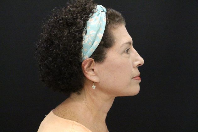 Face & Neck Lifts Case 7 - After