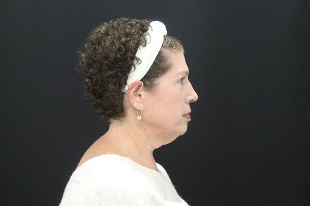 Face & Neck Lifts Case 7 - Before