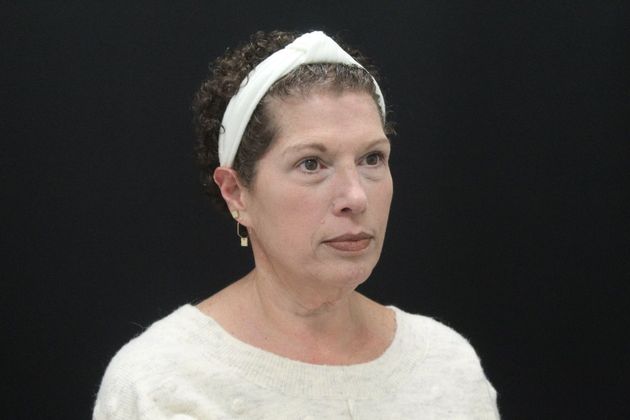 Face & Neck Lifts: Case 7 - Before