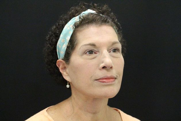 Face & Neck Lifts: Case 7 - After