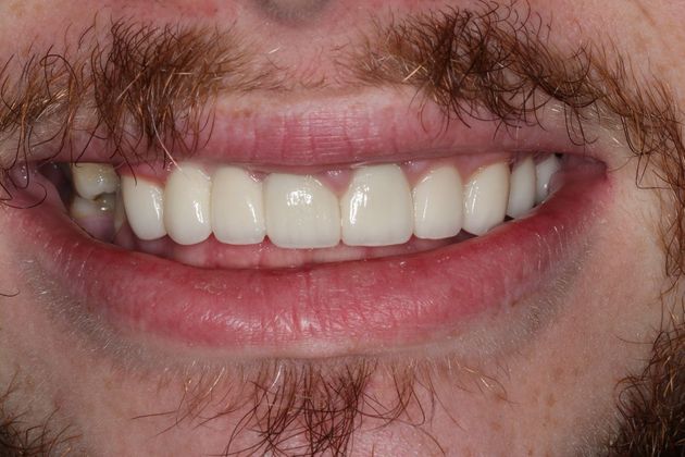 Dental Crowns Case 31 - After