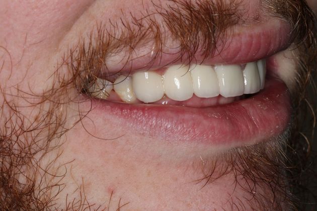 Dental Crowns: Case 31 - After