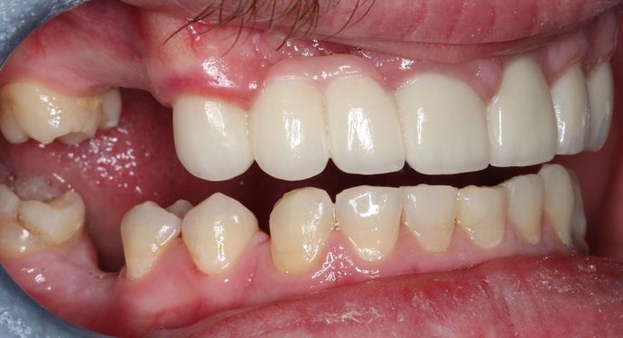Dental Crowns: Case 31 - After