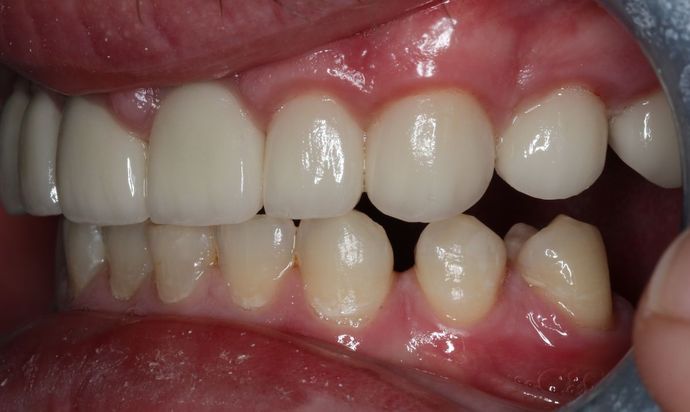 Dental Crowns: Case 31 - After